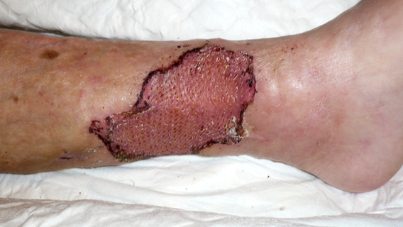 skin graft ulcer